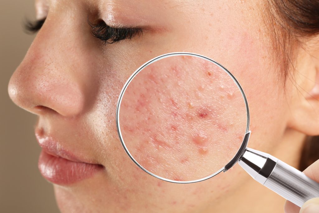 Acne How To Get Rid Of Them