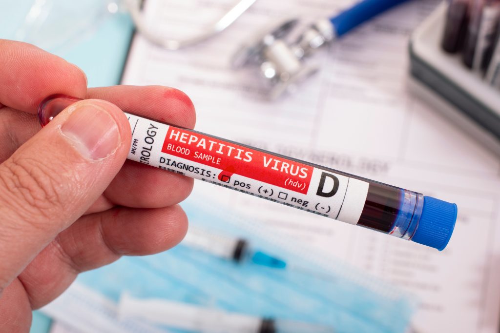 Hepatitis D - Cause, Symptoms and Treatment Hepatitis D - Cause, Symptoms and Treatment