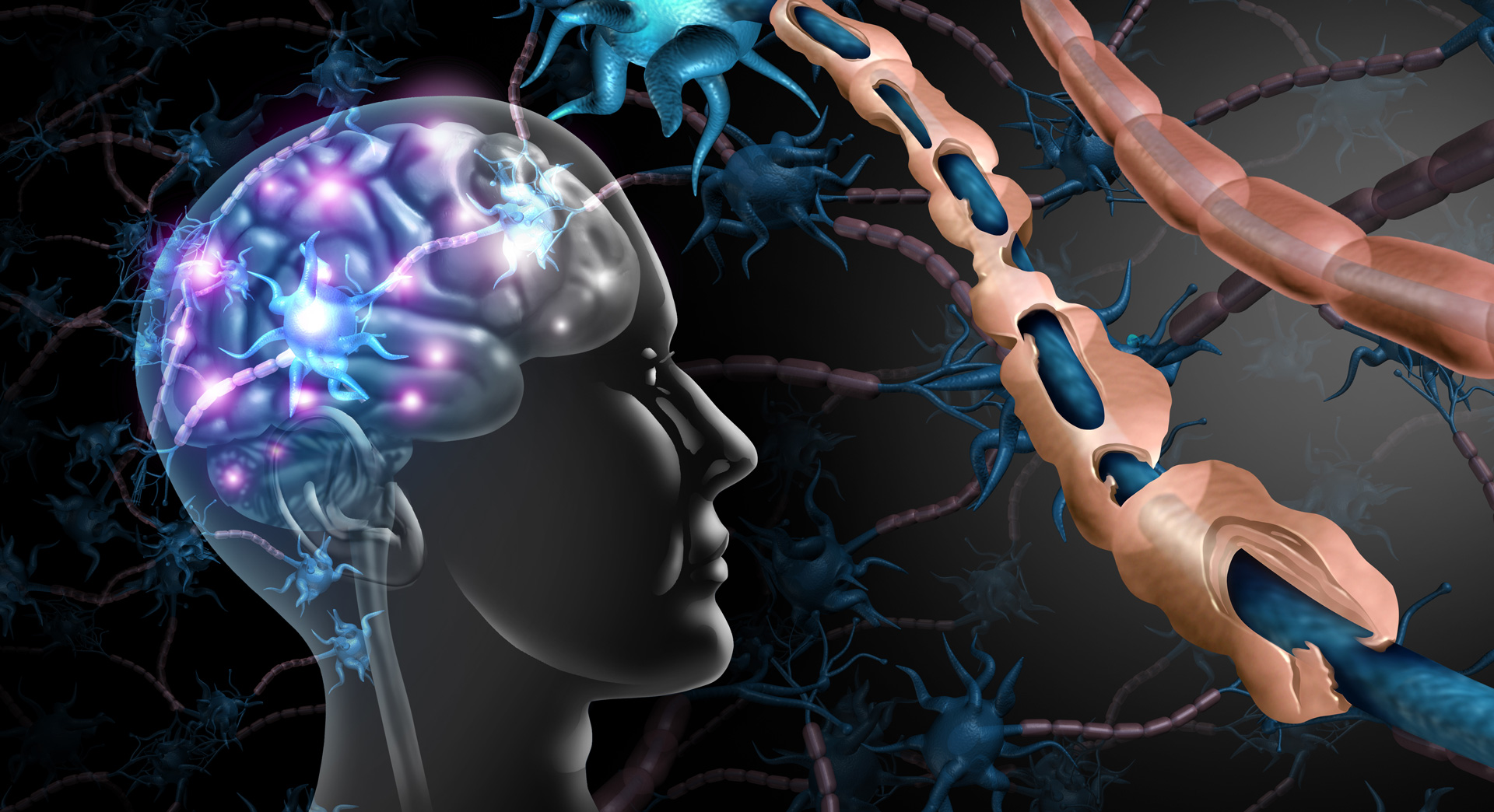 multiple sclerosis Multiple sclerosis - symptoms, treatment and cause
