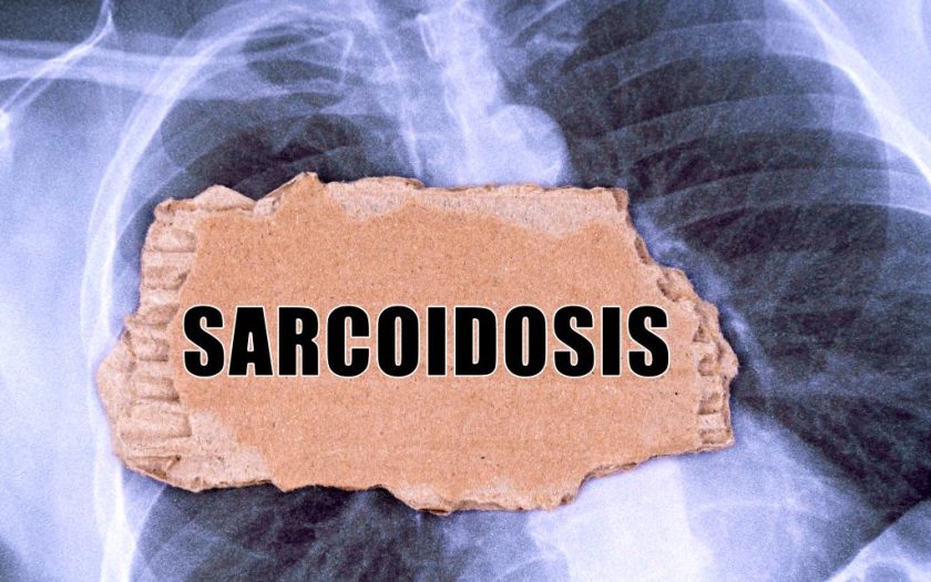 Sarcoidosis - cause, symptoms, treatment