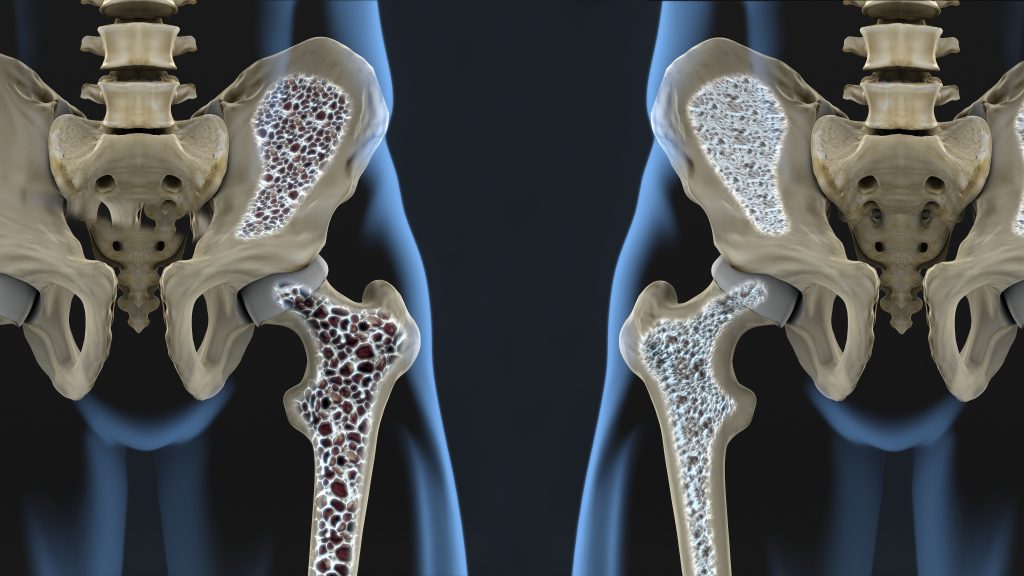 What is osteoporosis, what are the symptoms and how is it treated What is osteoporosis, what are the symptoms and how is it treated